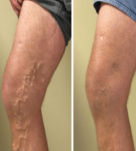sclerotherapy-before-and-after-3